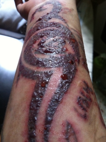 blisters | Tracking Maia Lee's Laser Tattoo Removal Journey
